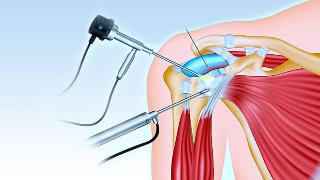 Артроскопия плечевого сустава