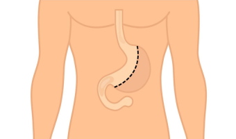 Проведение операции по уменьшению желудка