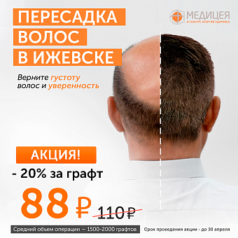 Бесшовная пересадка волос в Ижевске