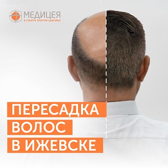 Бесшовная пересадка волос в Ижевске